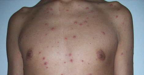scars-and-spots-10-ways-to-deal-with-chicken-pox-skin-damage